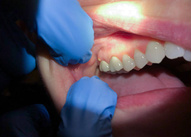 Best Emergency Dental Care for Broken or Chipped Teeth in Gatesville, TX